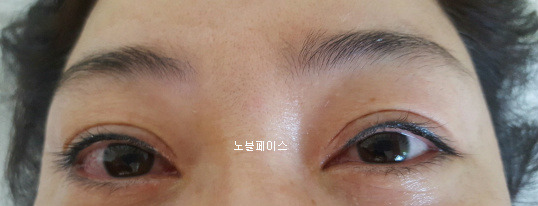일산 노블페이스 고급점막라인 비포&애프터~!