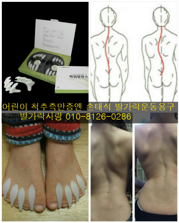 어린이 척추측만증